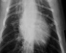 Baixa névoa 11 x filme de raio X 14 de papel para as impressoras a laser médicas KND-K