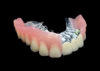 Mejora tu sonrisa Puente de corona PFM de aspecto natural y dentaduras removibles Combinación