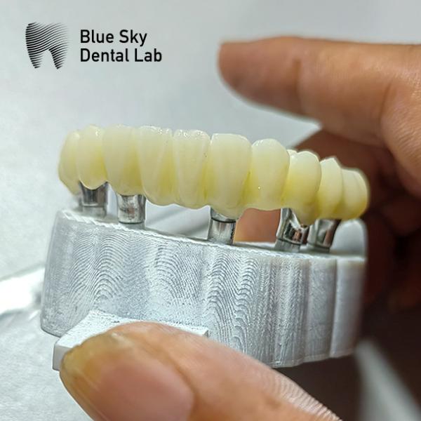 Esterilización por vapor Corona de implante único Corona de implante dental de superficie lisa