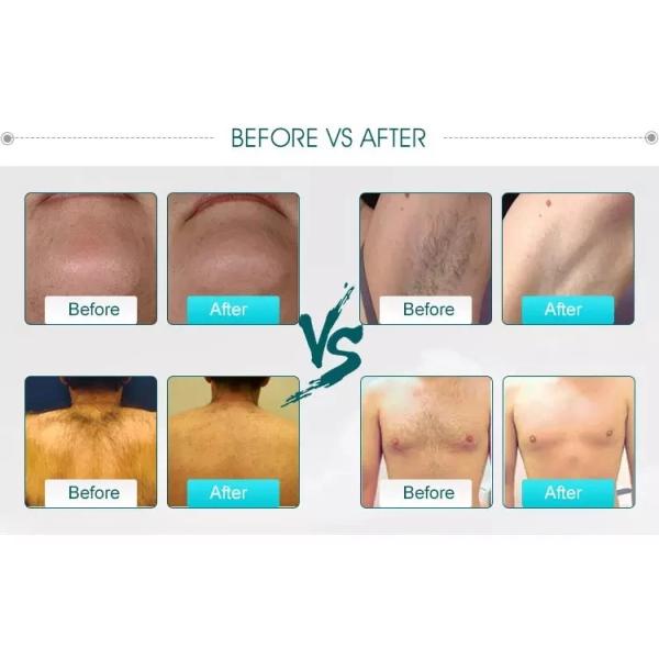 Medical CE approved 1200w Tripple wavelength 808 755 1064 diode laser professional hair removal