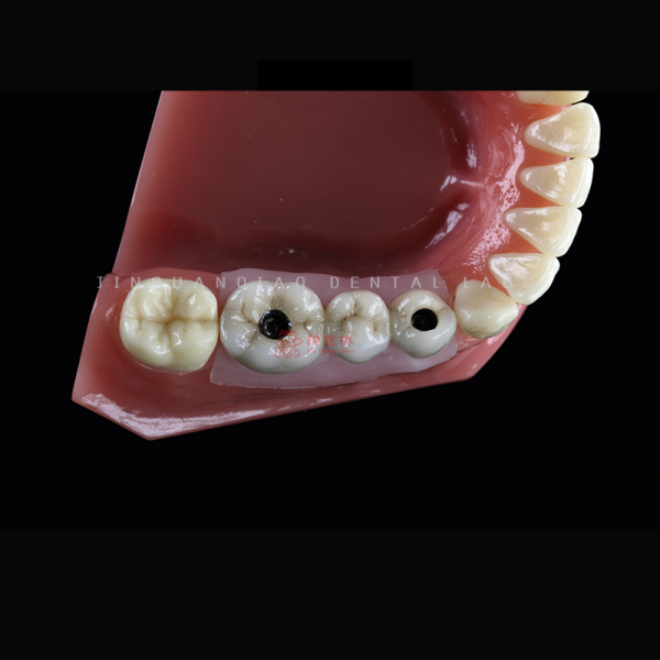 Endosteal Dental Implants Bridges or Removable Dentures Lab China