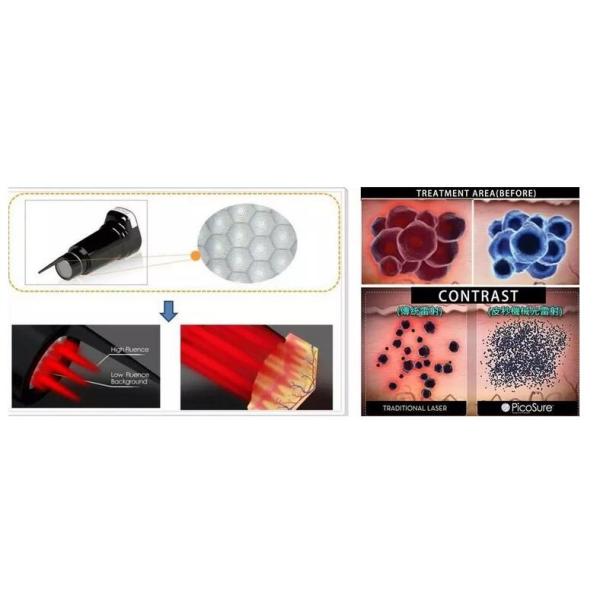 Portable Picosure Laser Machine Multi Functional Red Or Gray Color Optional