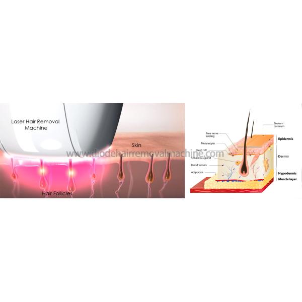 Salon Diode Laser Hair Removal Machine Skin Rejuvenation Safe Permanent