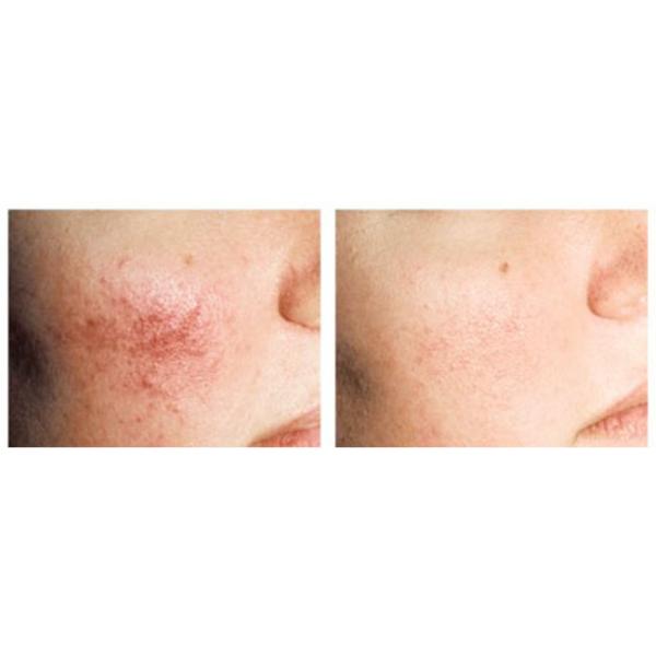 980nm Clinical Use Vascular Vein Removal Laser For Leg Varicose Removal