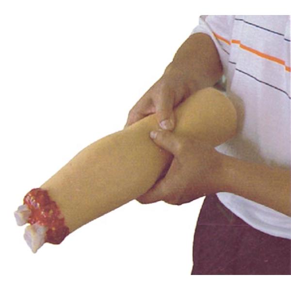 Trauma Nursing Care Model Arm Amputation and Hemostasis for Upper Limb Wound Treatment