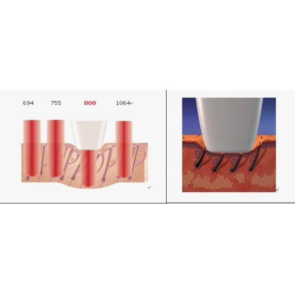 Factory price 810nm diode laser permanent hair removal 808nm on sale