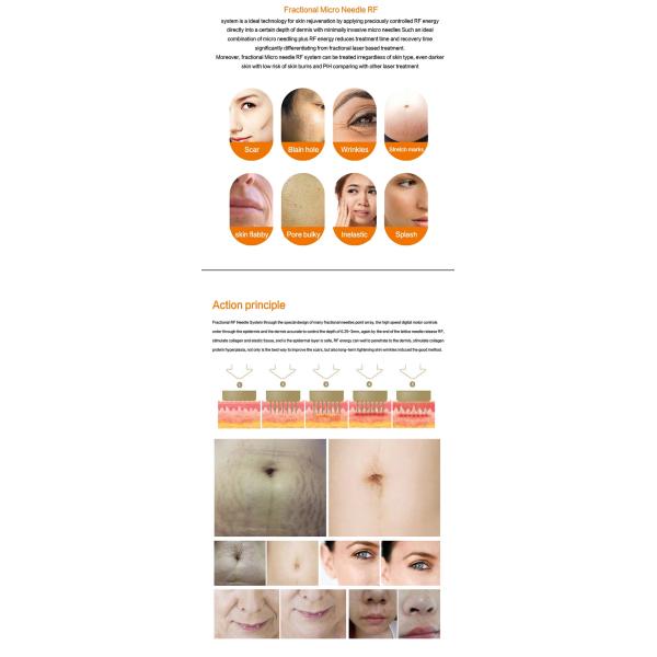 Машина RF Microneedling льда золота с угорь извлекая ручку для салона красоты