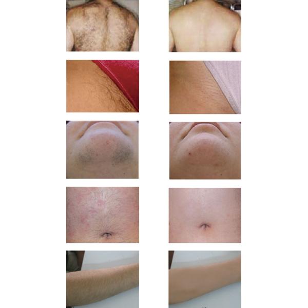 808nm laser hair removal machine diode for sale