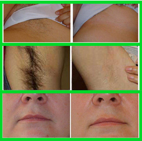 Movable Screen Skin Tightening E- Light Hair Removal Machine For Acne