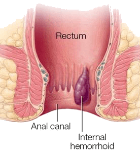 Dual Wavelength Laser Therapy Machine 980nm 1470nm Hemorrhoid Removal