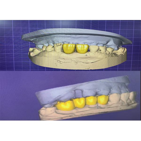 Специализированная эстетическая циркониевая зубная корона, идеально подходит для передних и задних зубов