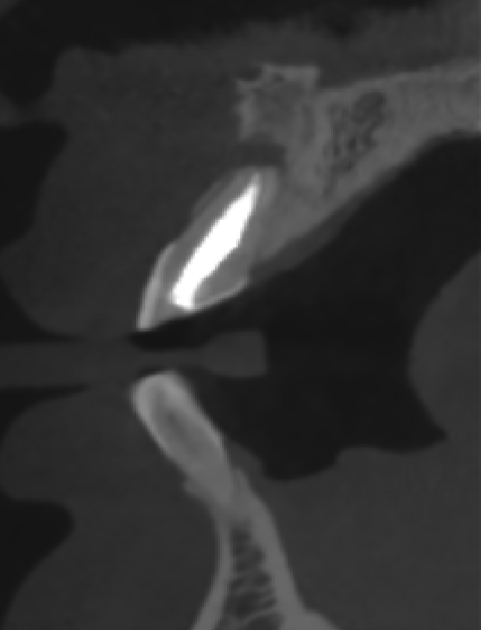 Dental Implant Orthodontic CBCT System High-Resolution 3D Imaging for Precise Diagnosis
