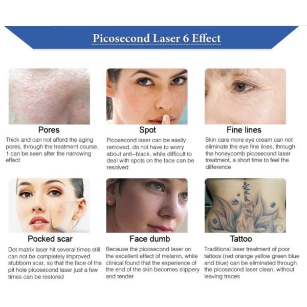 Picosecond Laser Tattoo Removal Machine Light Guiding Arm 7 Joints 1064nm