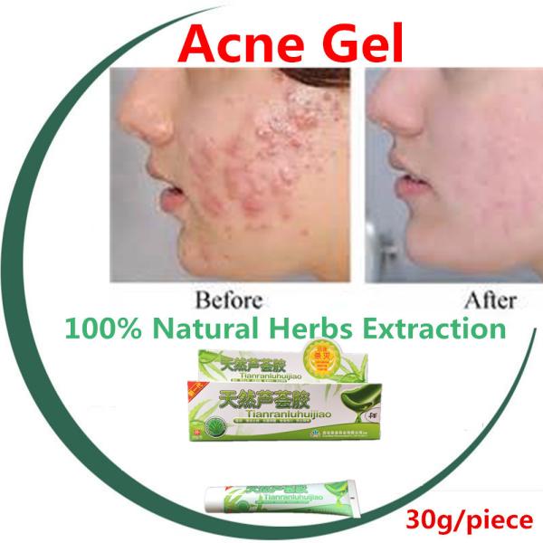 natural anti-bacteria gel anti acne anti eczema herbal gel