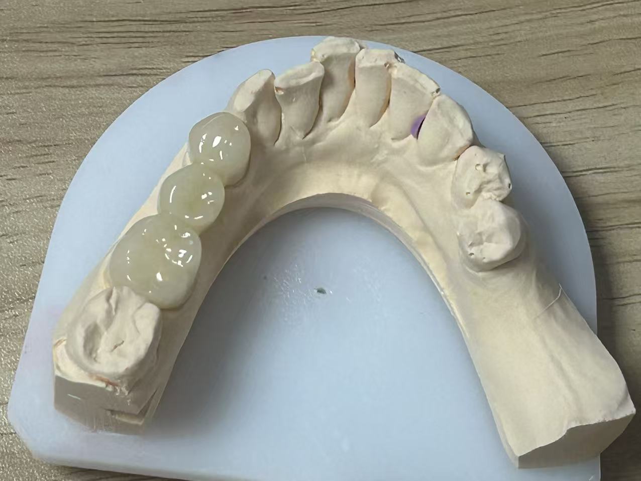 Custom CAD/CAM Digital Design Temporary Teeth with Natural Appearance and Comfortable Fit for Dental Restoration
