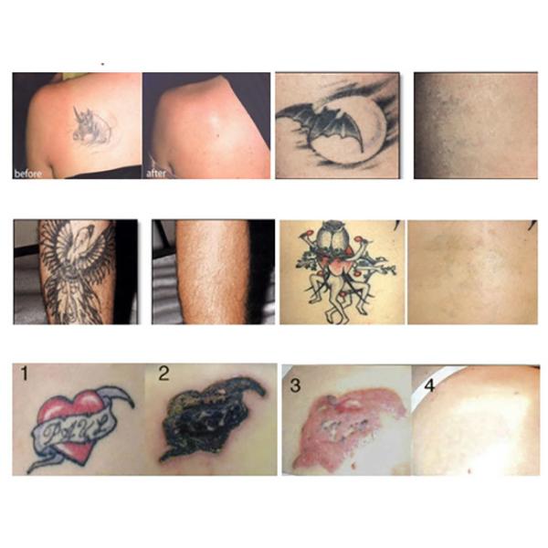 CE одобрил ультракрасную машину лазера ND YAG удаления угорь