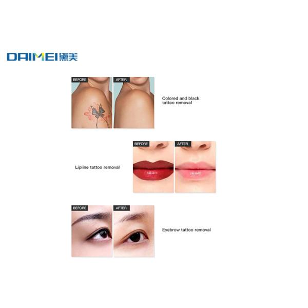 High Energy Q Switch Nd Yag Laser Machine for Laser Tattoo Remova 1064nm 532nm