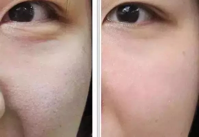Сыворотка заполнителя Meso решения Hyamely 5ML Hyaluronic кисловочная дермальная