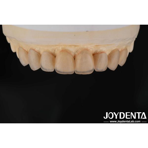 Apariencia natural Carillas cerámicas de vidrio, carillas de clínica dental