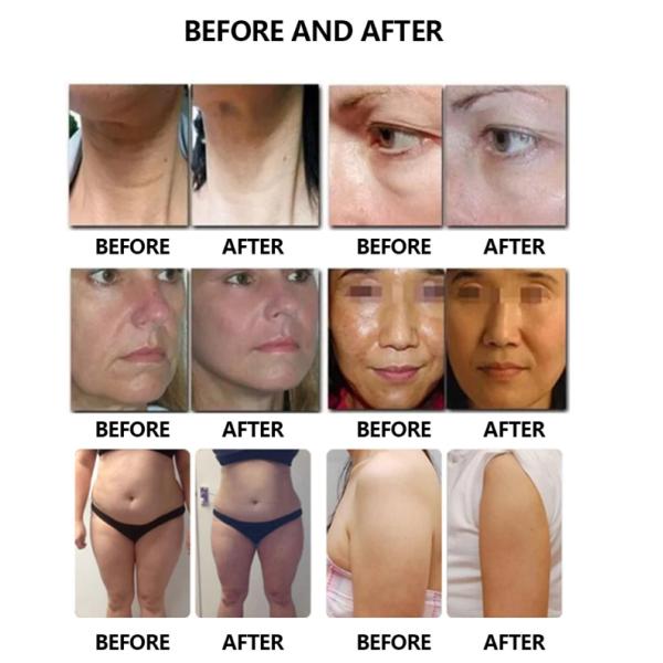 Latest Hifu 7D Focused Ultrasound 7D Hifu Body And Face Slimming Machine 7D Hifu For Winkle Removal