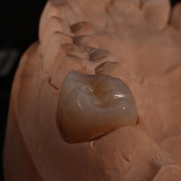 Полный контур Прозрачная цирконовая корона для эстетических результатов