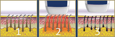 la fibre 600W a couplé l'épilation permanente de laser de diode de la Manche de laser Epolitor de la diode 808nm non