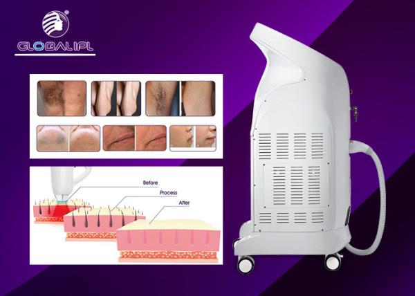 Permanent Hair Removal 808nm Diode Laser Hair Removal Beauty Machine
