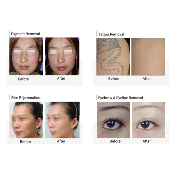 Удаление волос лазера диода удаления 808nm татуировки Nd Yag и лазер 2 Pico в 1