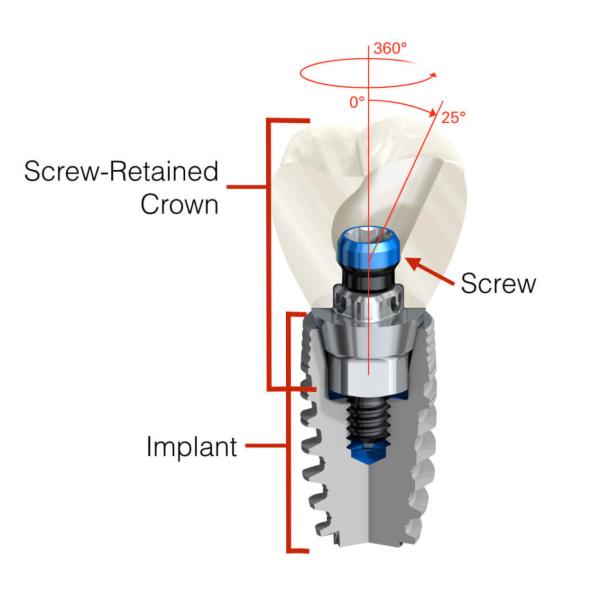 Винт зубного имплантата Duable установил винт титана медицинский