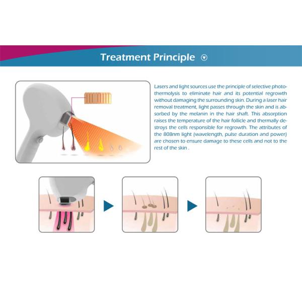 Новая безболезненная 808nm диодная лазерная эпиляция для клинического использования