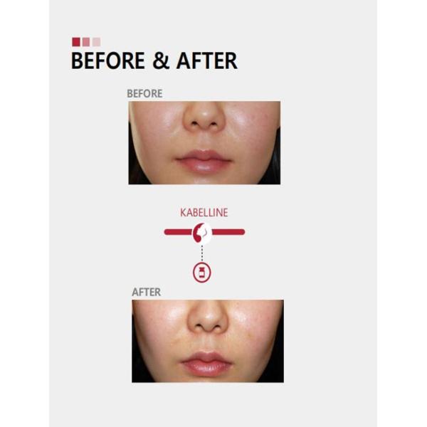 Уменьшение веса Kabelline Растворяющий жир Раствор для инъекций Кибелла дезоксихоловая кислота