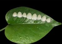 Minima preparação Veneer de porcelana EMAX para tratamento cosmético dentário