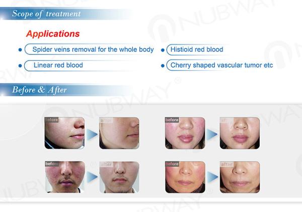 Effective 30Mhz painfree RBS spider veins removal machine for vascular removal