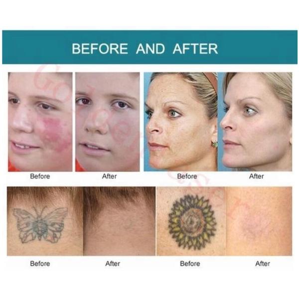 Q Switched Nd Yag Tattoo Removal Machines , High Power Pico Laser Machine