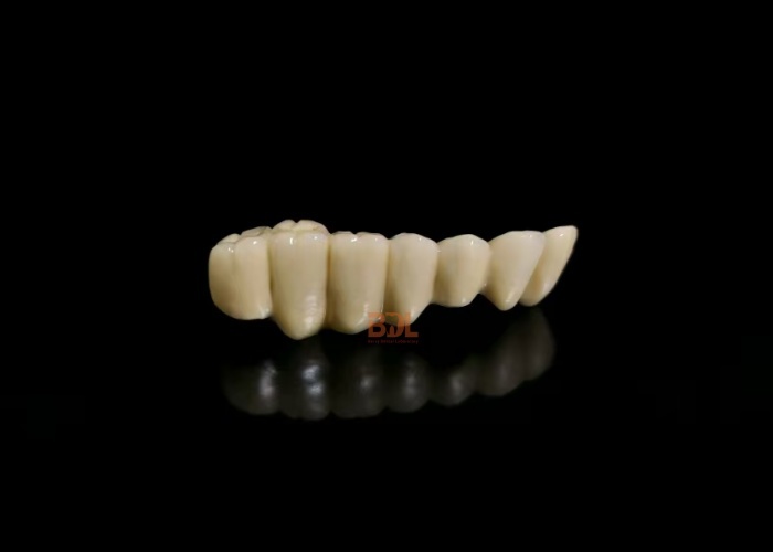 Custom Porcelain Fused To Metal Restorations Offering Superior Strength and Natural Appearance for Optimal Dental Outcomes