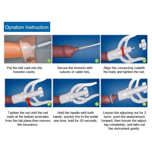 Легко используемое медицинское устройство одноразовое обрезание для мужчин