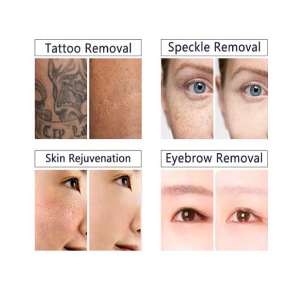 Tattoo Removal ND YAG Laser Machine