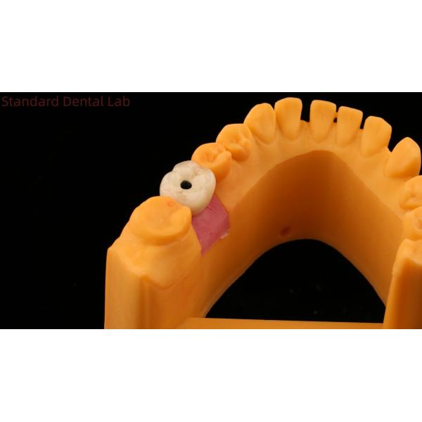 Screw Retained Dental Implant Crown Dental PFM Crown With 3D Print Model