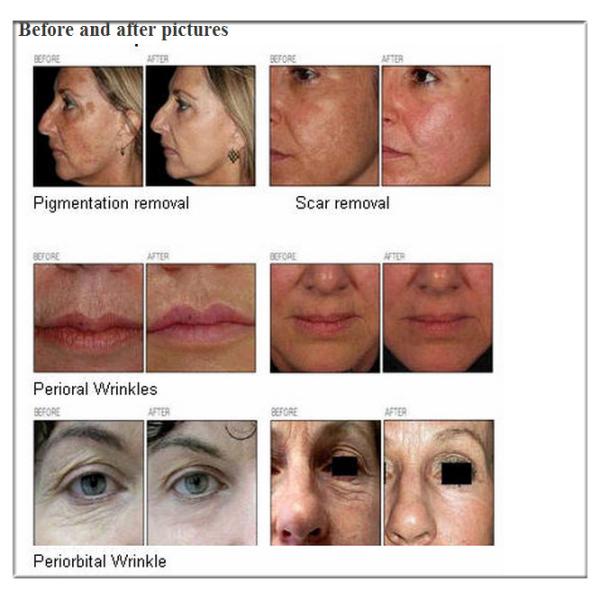 Mdical Fractional Co2 Laser Machine for Scar Removal /  Vaginal rejuvenation