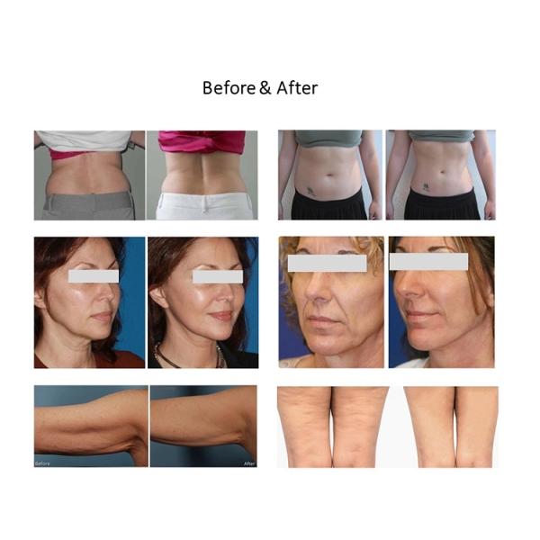 El equipo 4D de la belleza del RF del hogar - circunde la máquina de elevación facial de rv