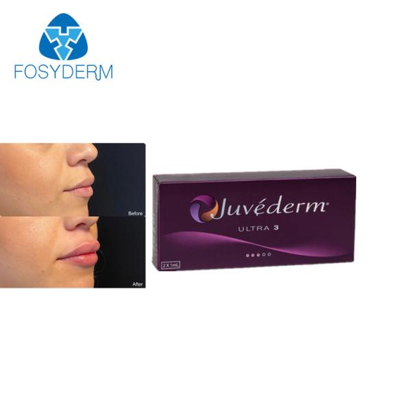 Realce ácido hialurónico do bordo dos enchimentos de Juvederm 2ml