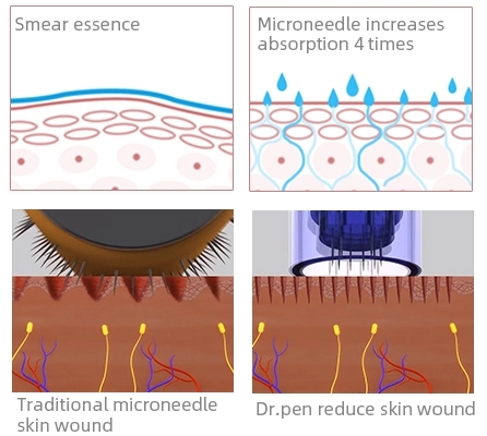 Rechargeable Dr. pen N2 W 5 Speed Auto Microneedle System for Stretch Mark Removal