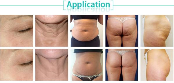 BeautySalon Equipment weight loss machine fat burning instrument vacuum cavitation y radiofrecuencia cavitation home use
