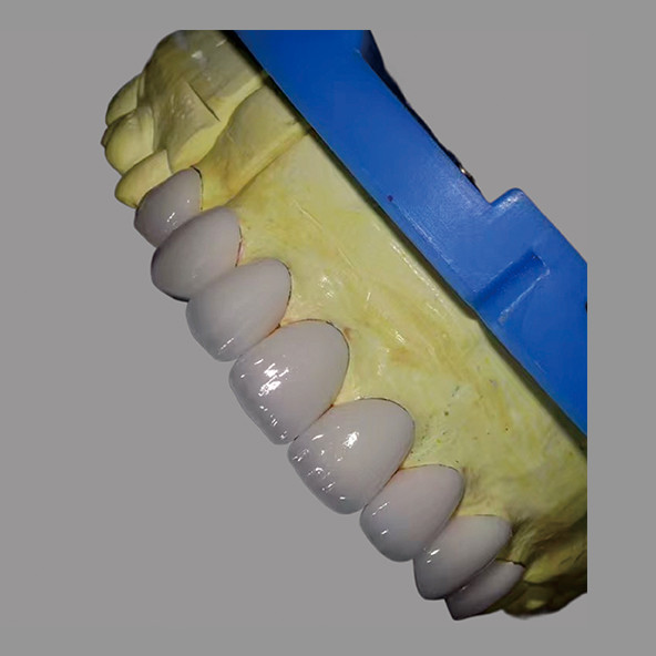 High Translucency IPS E Max Veneers Stains Resistant Biocompatible