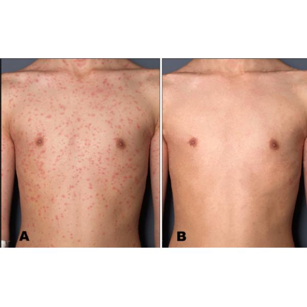 Handheld Psoriasis Light Therapy Equipment , UV Light Treatment For Vitiligo