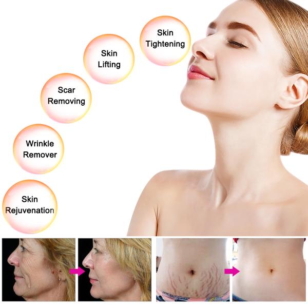 Коммерчески машина Rf Microneedle Rf красоты подмолаживания кожи