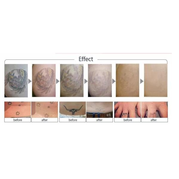 Q Switch Nd Yag Laser Tattoo Removal Equipment / Alexandrite Laser Tattoo Remover Machine