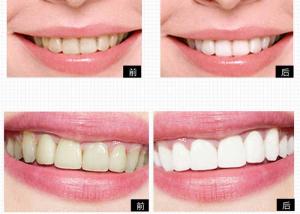 Private Logo Personal Care Products Tooth Bleaching System For Home Teeth