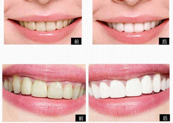 Sistema privado do descoramento de Logo Personal Care Products Tooth para o alvejante dos dentes da casa