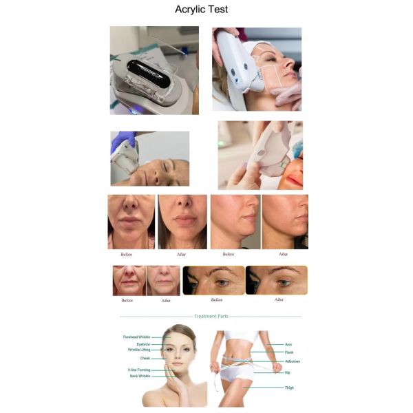 Facial Lifting Smas Ultrasound HIFU Beauty Machine for Wrinkle Removal